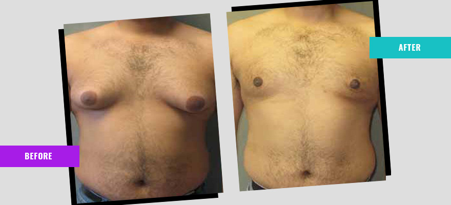 Gynaecomastia in Gurugram