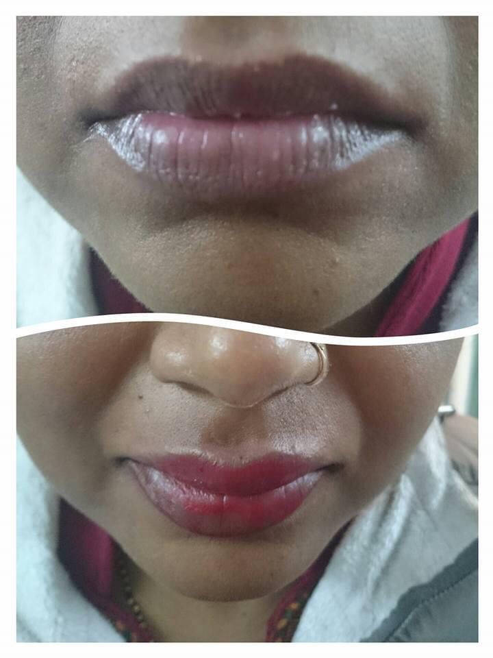 Permanent Makeup for White Patches(vitiligo)